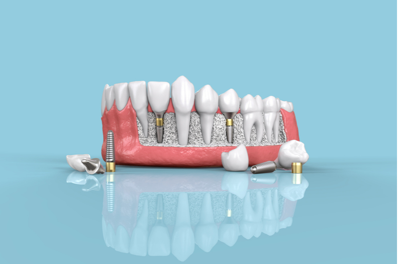 Get Help For Your Dental Implants With These Grants